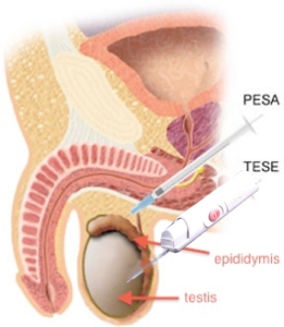 Beberapa cara untuk memperoleh sperma pada kasus azoospermia (type sumbatan)